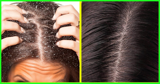 What in the world causes dandruff? (& simple ways to get rid of it for good)